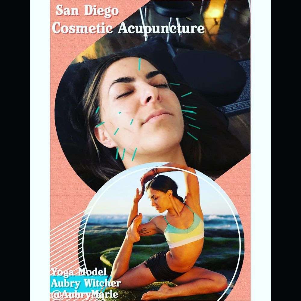 San Diego Cosmetic Acupuncture | 10459 San Diego Mission Rd, San Diego, CA 92108, USA | Phone: (855) 732-2878