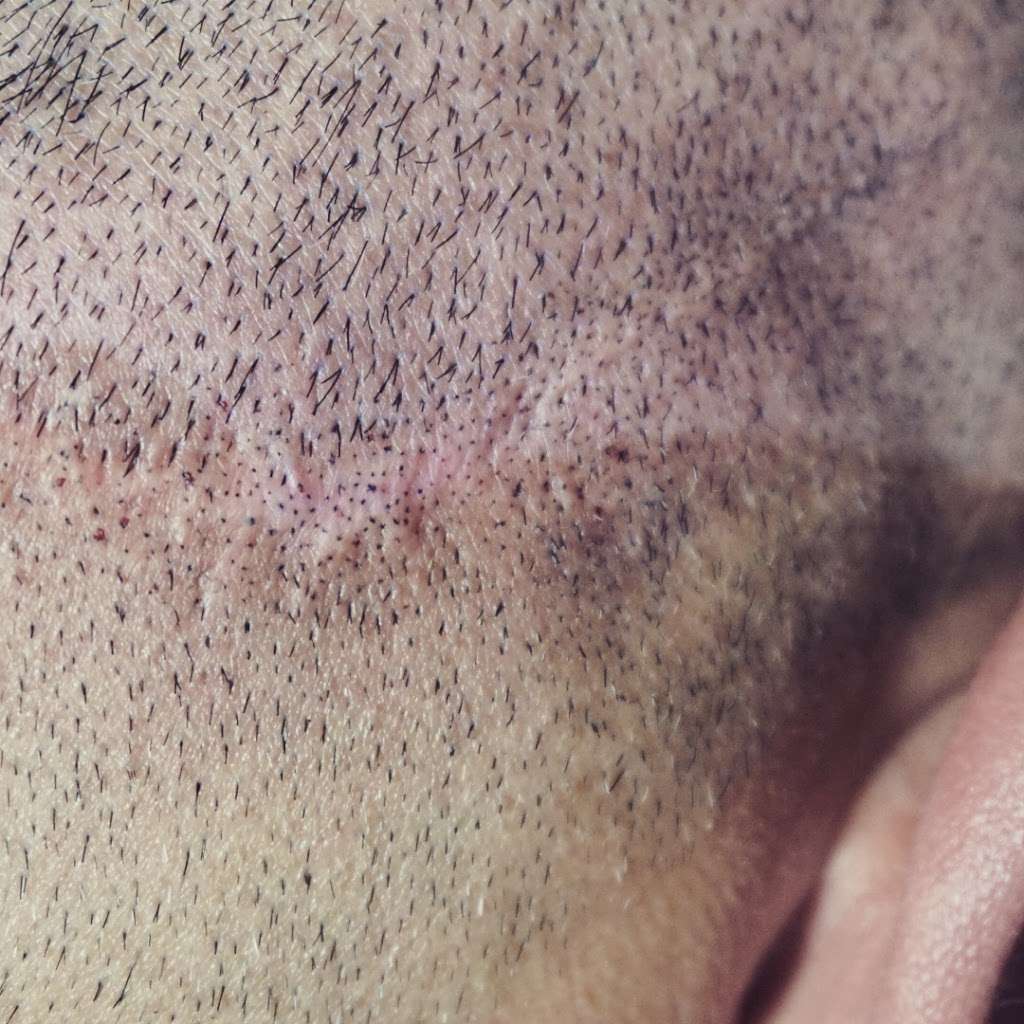 Picasso Scalp Micropigmentation - Chicago | 7550 Archer Rd unit b, Justice, IL 60458, USA | Phone: (480) 547-6246