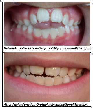 Facial Function Orofacial Myofunctional Therapy | 9404 Tiller Dr, Ellicott City, MD 21042, USA | Phone: (410) 707-7235