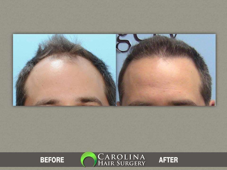Carolina Hair Surgery: FUE Hair Transplant | 1021 Maxwell Mill Rd, Fort Mill, SC 29708, USA | Phone: (803) 217-3065