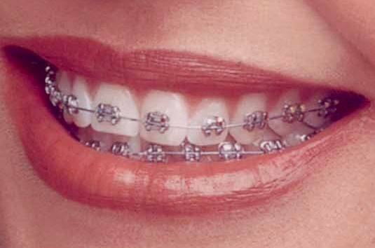 Smiles By Alex | 8884 Warner Ave, Fountain Valley, CA 92708, USA | Phone: (714) 962-2788