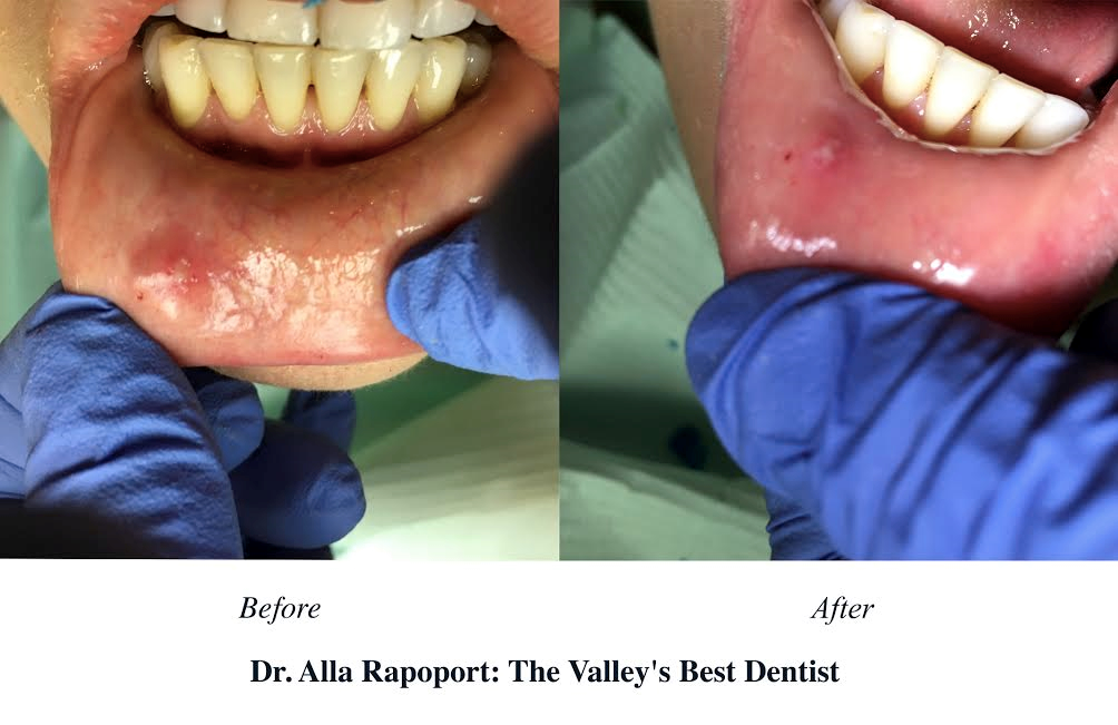 Alla Rapoport DDS | 7601 Canby Ave Suite 4, Reseda, CA 91335 | Phone: (818) 774-9933