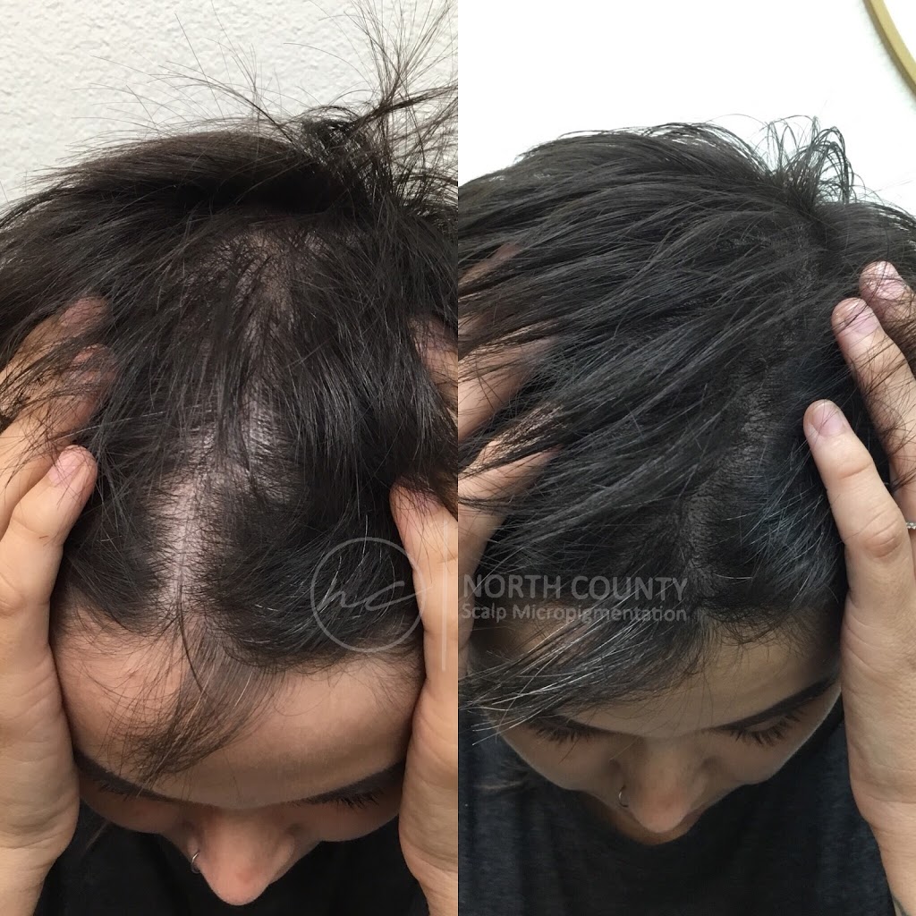 North County Scalp Micropigmentation | 1172, 1822 Marron Rd, Carlsbad, CA 92008, USA | Phone: (760) 805-6801