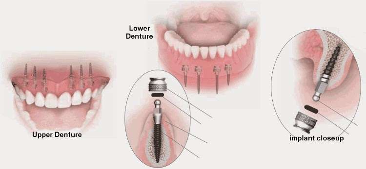 Mini Dental Implant Center Polk City, FL | 120 Carter Blvd #7, Polk City, FL 33868, USA | Phone: (863) 984-0000