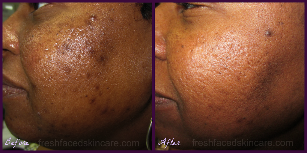 Fresh Faced Skin Care | 204 Delaware St, New Castle, DE 19720, USA | Phone: (302) 689-3223