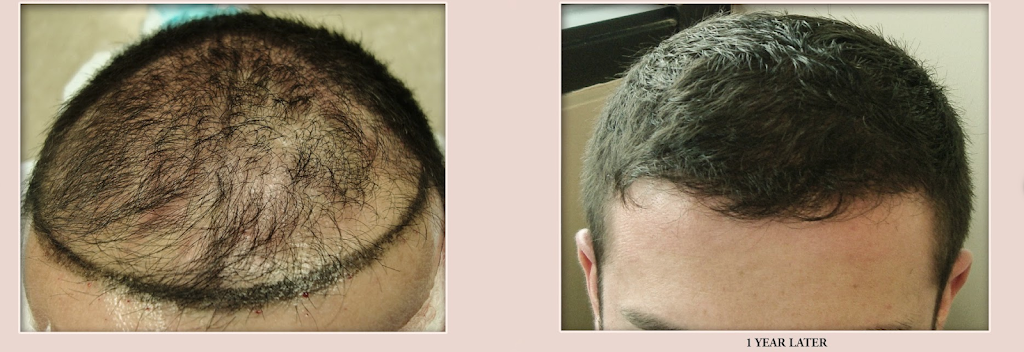 Advanced Hair Transplants | 2779 Sunridge Heights Pkwy #110, Henderson, NV 89052, USA | Phone: (702) 994-2133