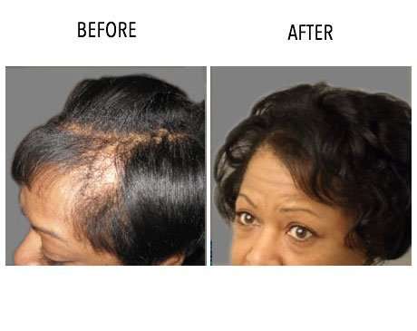 Capri Hair Restoration | 2813 Bristol Pike, Bensalem, PA 19020, USA | Phone: (877) 602-2774