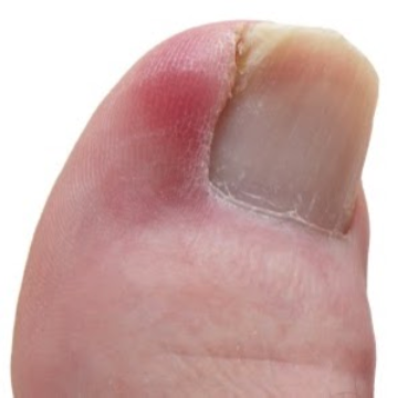 Ingrown Toenail Treatment in Toenail Fungus Treatment Center | 220A St Nicholas Ave, Brooklyn, NY 11237, USA | Phone: (424) 299-4627