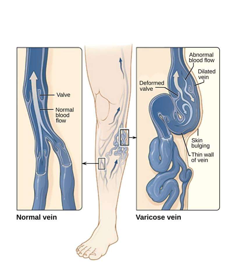 The Center For Advanced Vein Therapy | 2600 Philmont Ave Suite 205, Huntingdon Valley, PA 19006, USA | Phone: (267) 728-7440