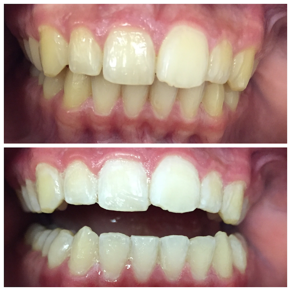 Lumin Teeth Whitening | 12841 Jones Rd #208, Houston, TX 77070, USA | Phone: (281) 463-4601