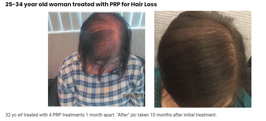 PRP Hair Loss Treatment Center - hair care  | Photo 8 of 8 | Address: 2 Hospital Plaza, Old Bridge, NJ 08857, USA | Phone: (732) 859-3193