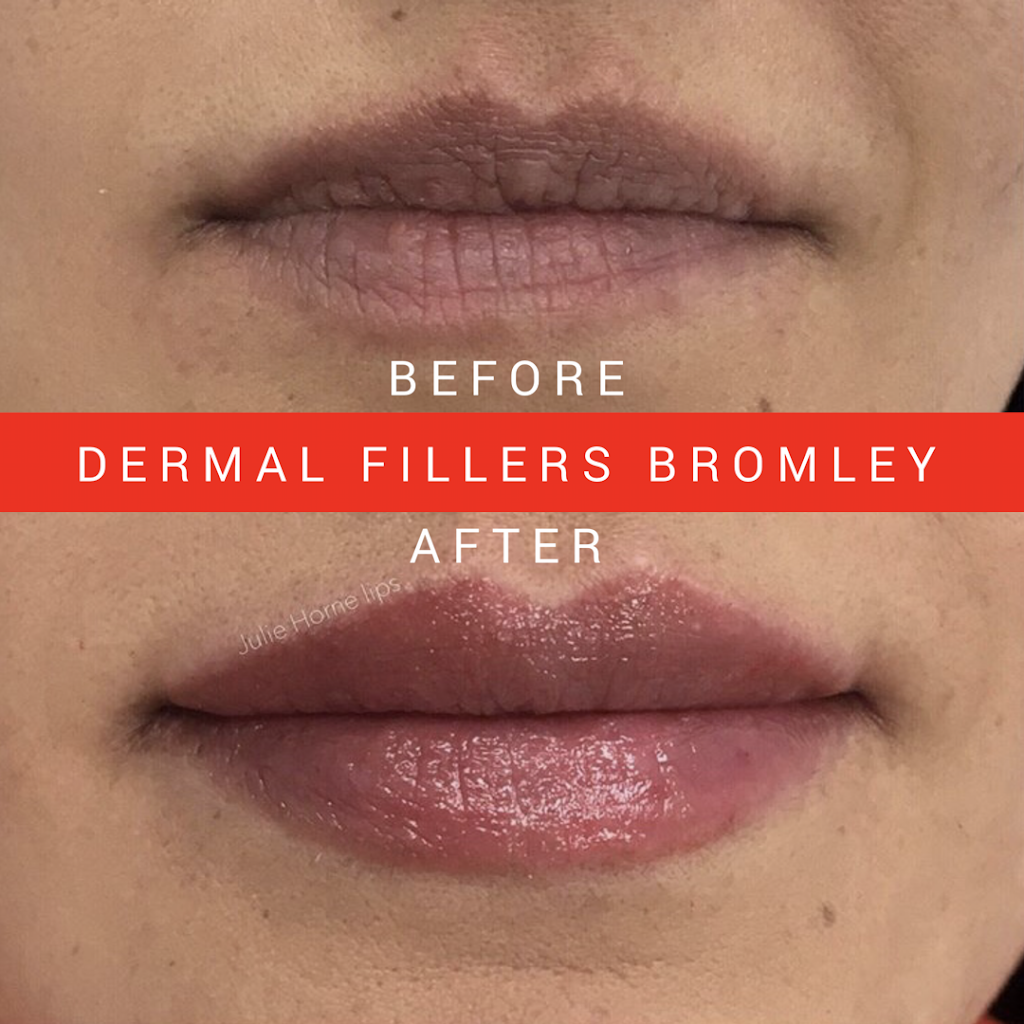 Dermal Fillers Bromley | Westbury Rd, Bromley BR1 2QB, UK | Phone: 07740 088563