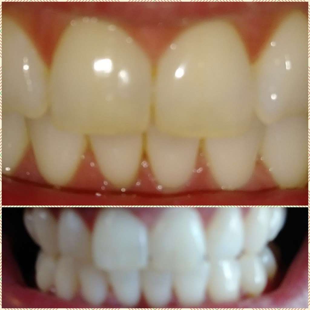 Yevonne’s laser teeth whitening LLC | 4933 S Carson St APT 212, Aurora, CO 80015, USA | Phone: (720) 629-9030
