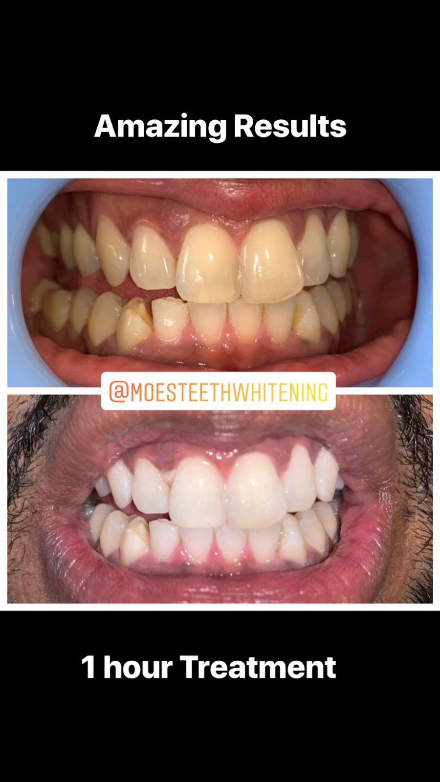 Moes Teeth Whitening | 1530 Jamacha Rd. #X, El Cajon, CA 92019, USA | Phone: (619) 922-1280
