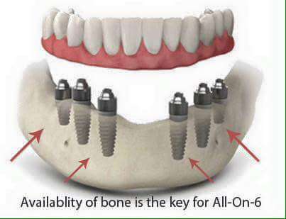 SB Valley Dentistry | 555 S Mt Vernon Ave #G, San Bernardino, CA 92410, USA | Phone: (909) 384-7374