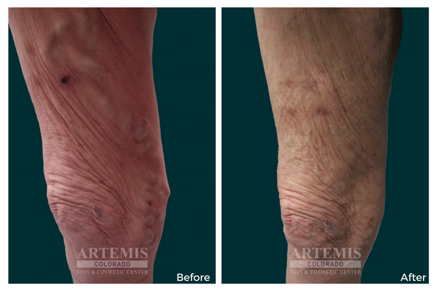 Artemis Colorado - Vein & Cosmetic Center | 10431 Town Center Dr #400, Westminster, CO 80021, USA | Phone: (303) 955-8314