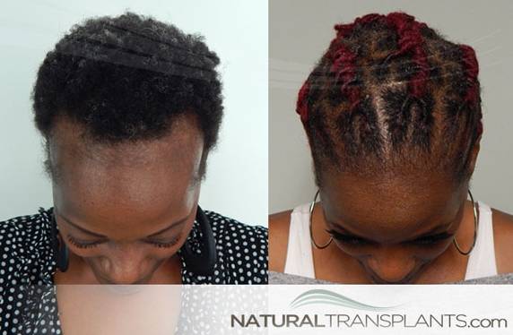 Natural Transplants, Hair Restoration Clinic | 1228 E 7th Ave #200, Tampa, FL 33605, USA | Phone: (813) 440-2598