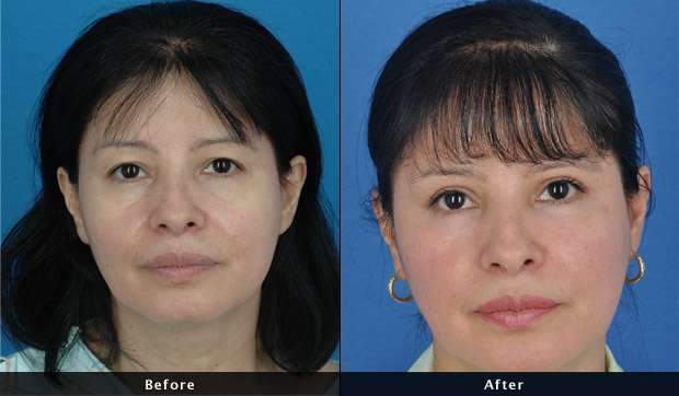Piña Cosmetic Surgery | 2530 W Holcombe Blvd, Houston, TX 77030, USA | Phone: (713) 661-5255