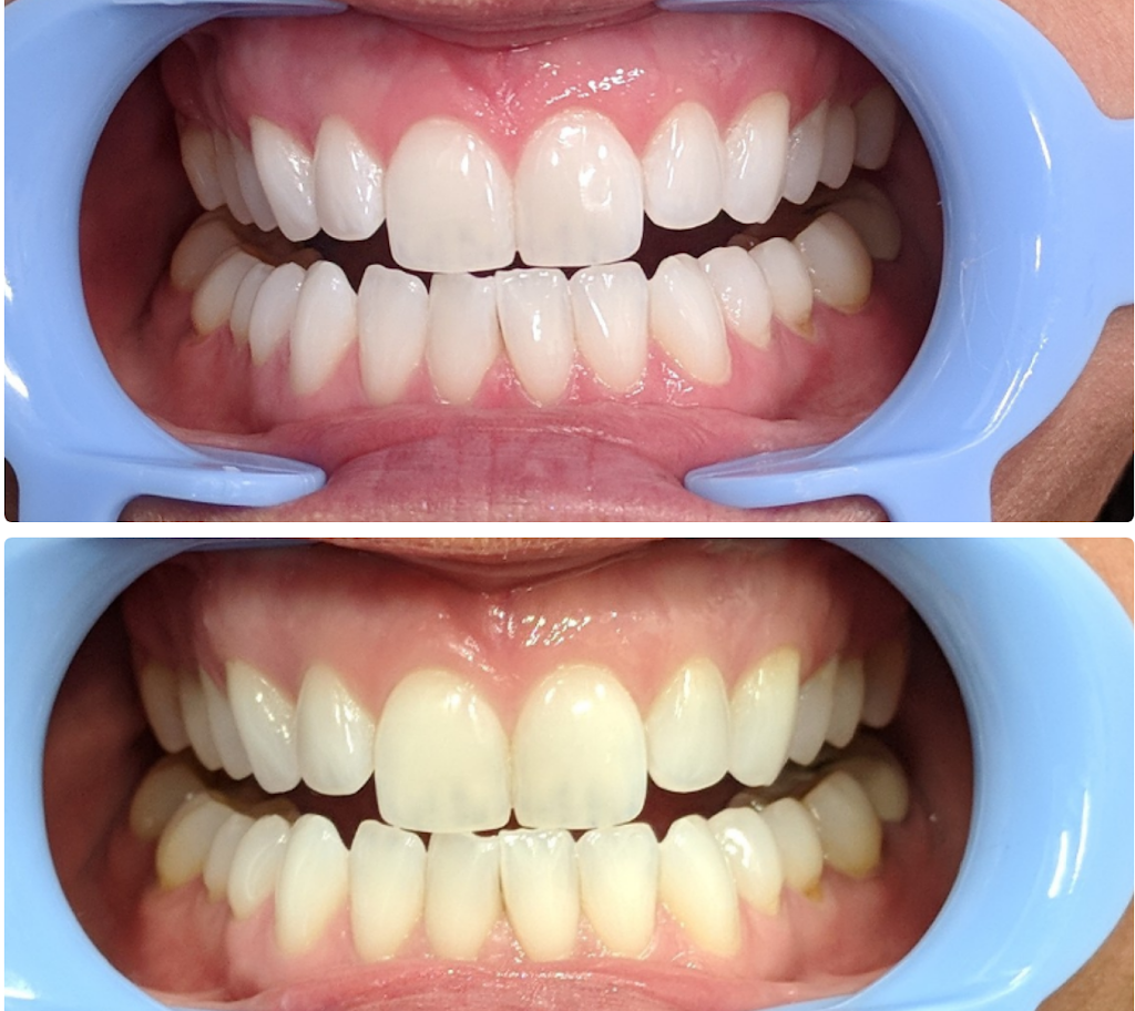 Lumina + Co. Teeth Whitening System | 1940 W Chandler Blvd #5 Studio 22, Chandler, AZ 85224, USA | Phone: (801) 500-1027