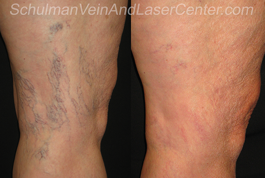 Schulman Vein and Laser Center, Dr. Lee G. Schulman M.D. | 800 Community Dr #211, Manhasset, NY 11030, USA | Phone: (516) 482-4477