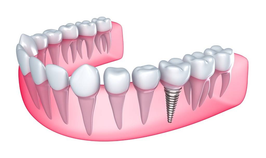 Michael Lee DDS, INC. | 9301 Fircrest Ln #6, San Ramon, CA 94583, USA | Phone: (925) 983-9299