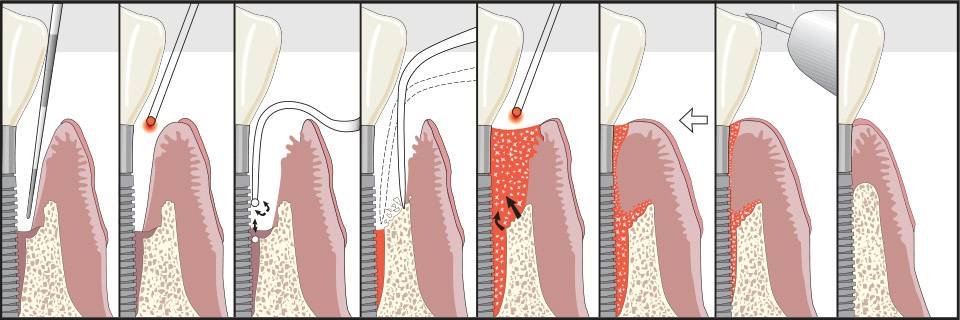 Periodontics and Dental Implants of North Carolina | 6101 Grace Park Dr, Morrisville, NC 27560 | Phone: (919) 493-9900