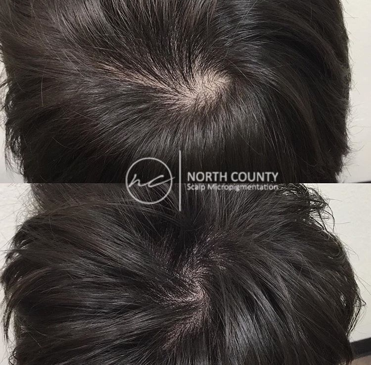 North County Scalp Micropigmentation | 1172, 1822 Marron Rd, Carlsbad, CA 92008, USA | Phone: (760) 805-6801