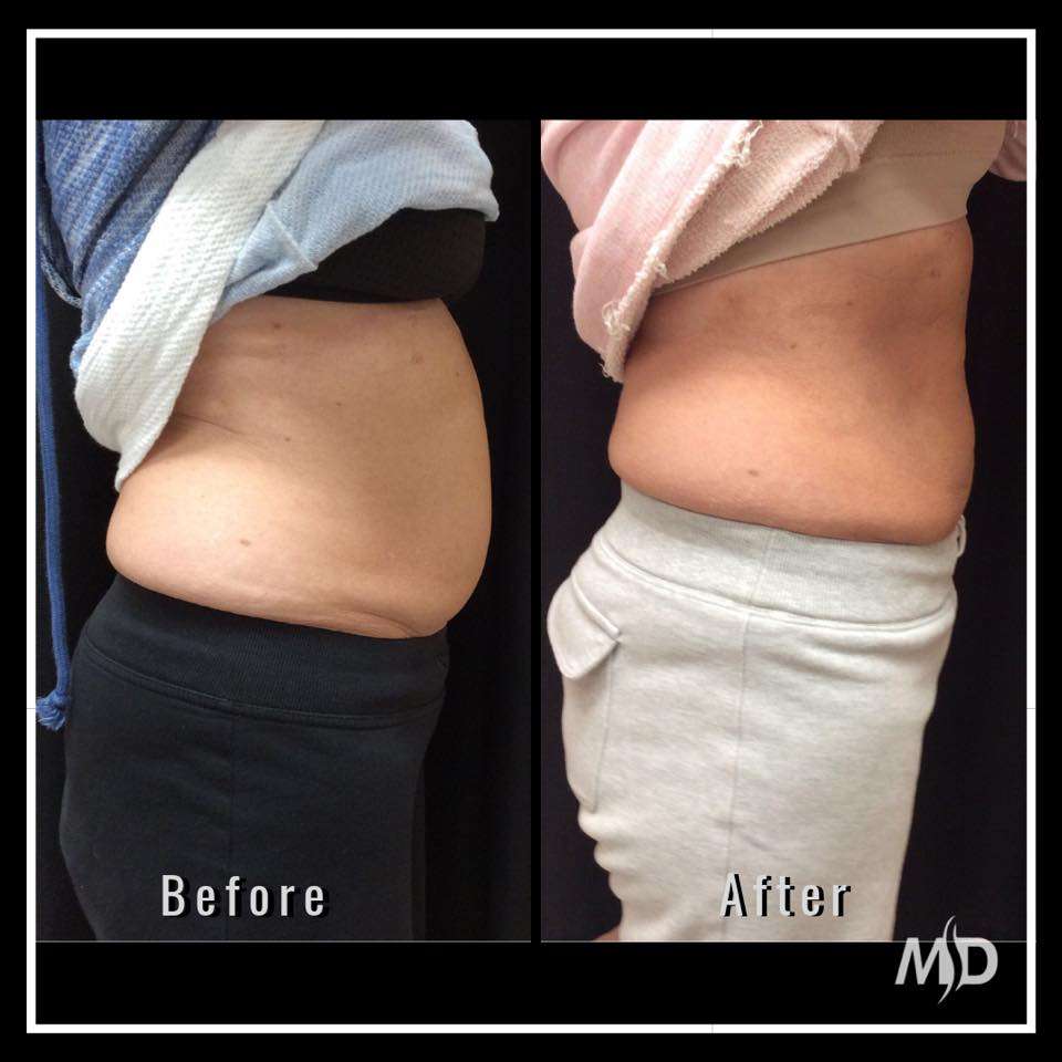 Metropolitan Dermatology - CoolSculpting Staten Island | 1324 Victory Blvd, Staten Island, NY 10301 | Phone: (718) 448-4488