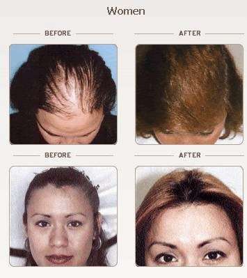 Hair Transplant Hair Loss | 588 Talbert Ave, Simi Valley, CA 93065, USA | Phone: (805) 584-3058