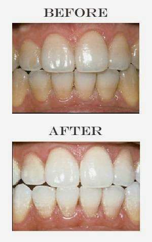 Ley Dentistry | 14555 Hazel Dell Pkwy Suite 130, Carmel, IN 46033 | Phone: (317) 975-0005