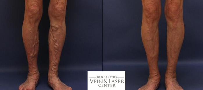 Beach Cities Vein & Laser Center | 390 CA-1 Suite 1030, El Segundo, CA 90245 | Phone: (310) 904-6681