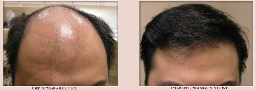 Advanced Hair Transplants | 2779 Sunridge Heights Pkwy #110, Henderson, NV 89052, USA | Phone: (702) 994-2133