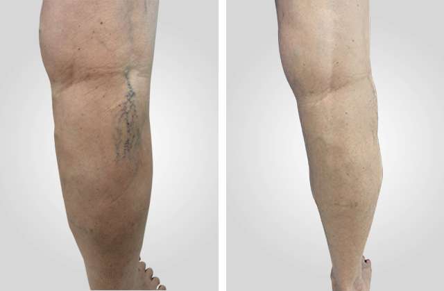 Boston Vein Care in Wellesley MA | 978 Worcester St #2, Wellesley, MA 02482, USA | Phone: (855) 798-3467