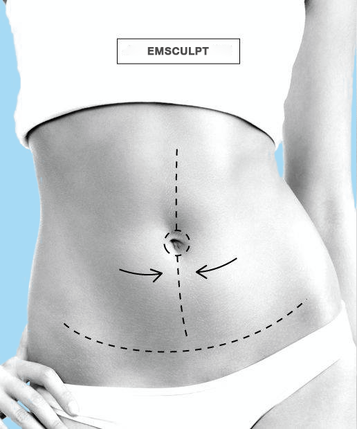 Emsculpt Seattle | 2620 Bellevue Way NE ste 212, Bellevue, WA 98004, USA | Phone: (929) 352-4101