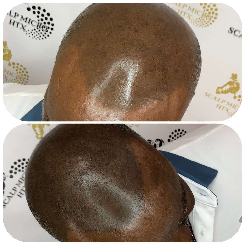 Scalp Micro HTX | 6510 Bellfort St C, Houston, TX 77087, USA | Phone: (832) 303-1722