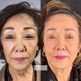 Dermal Filler Orange County | 14001 Newport Ave F, Tustin, CA 92780, United States | Phone: (714) 760-9918