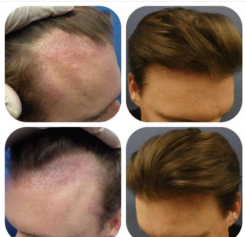 Meshkin Medical - Cosmetic Hair Restoration and Hair Transplant  | 912 W Glenoaks Blvd, Glendale, CA 91202, USA | Phone: (800) 246-8424