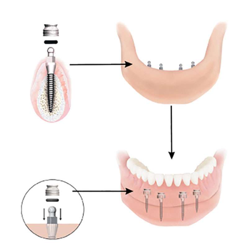 Dental Implant Solutions Glendale, NY | 76-01 Myrtle Ave #1, Glendale, NY 11385, USA | Phone: (718) 804-5579