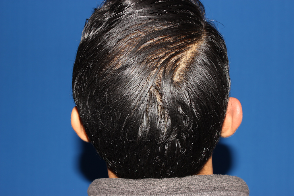 YAKER Hair Restoration + Med Spa (Joseph R. Yaker, MD) | 3242 Preston Rd #160, Plano, TX 75093, USA | Phone: (972) 468-8301