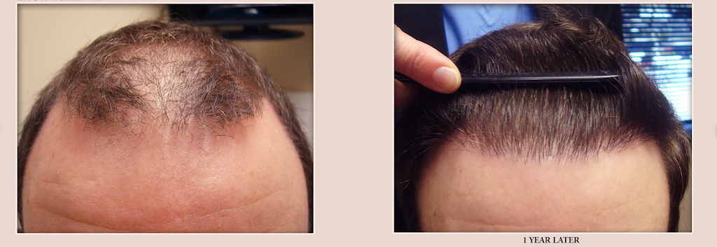 Advanced Hair Transplants | 2779 Sunridge Heights Pkwy #110, Henderson, NV 89052, USA | Phone: (702) 994-2133