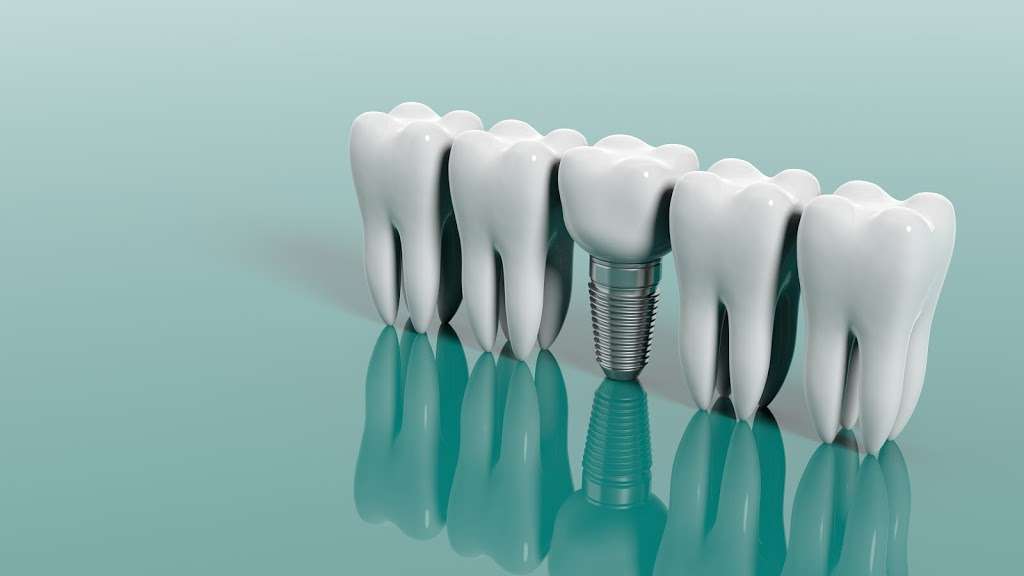 Vegas Implants & Dentures | 6002 S Durango Dr #100, Las Vegas, NV 89113, USA | Phone: (702) 518-2971