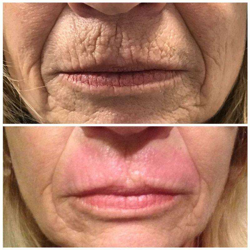 Plasma Skin Lifting NY | 5625 Post Rd #1, The Bronx, NY 10471, USA | Phone: (646) 377-0448