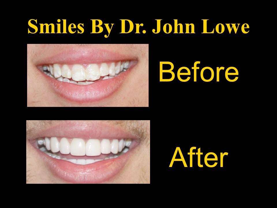 John Lowe DDS Frankton Family Dentistry | 100 E Sigler St, Frankton, IN 46044, USA | Phone: (765) 754-8583