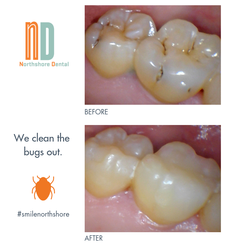 Northshore Dental | 2 Evanston St, Houston, TX 77015, USA | Phone: (713) 453-7466