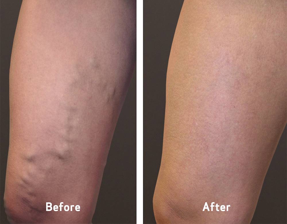 Vein Clinics of America | 232 Crossroads Blvd, Cary, NC 27518, USA | Phone: (919) 859-1276