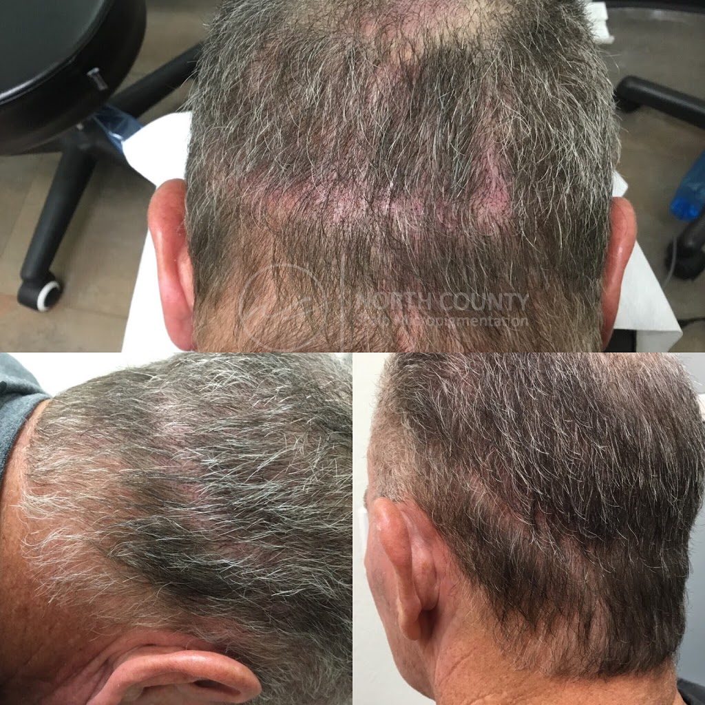 North County Scalp Micropigmentation | 1172, 1822 Marron Rd, Carlsbad, CA 92008, USA | Phone: (760) 805-6801