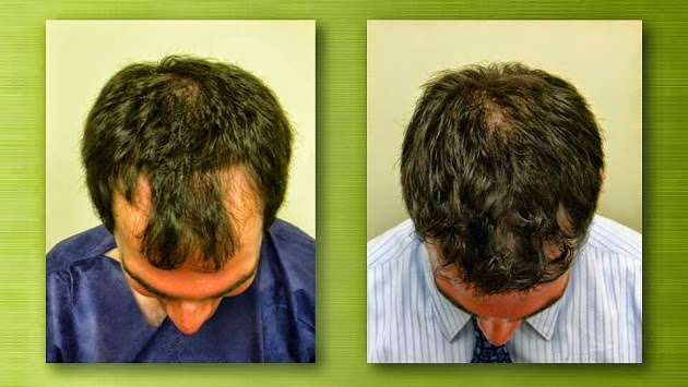 Tempus Hair Restoration | 5537 S Williamson Blvd #752, Port Orange, FL 32128, USA | Phone: (877) 877-5200