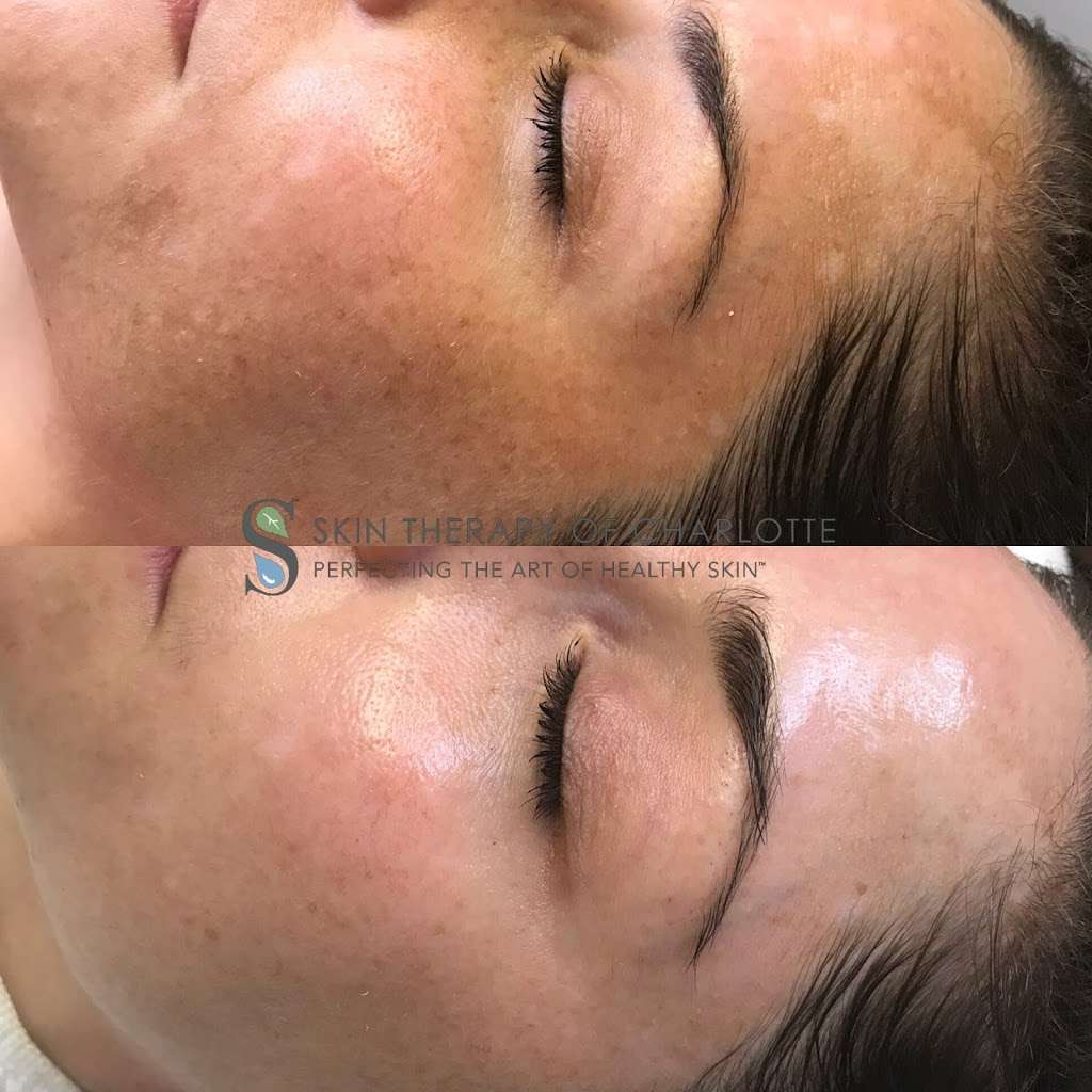 Skin Therapy of Charlotte | 10607 Rea Rd, Charlotte, NC 28277 | Phone: (980) 214-9676