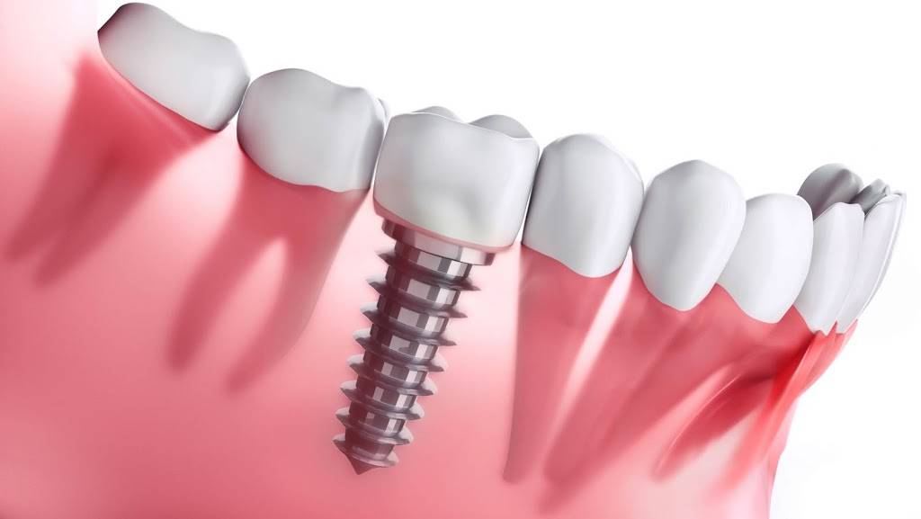 Tooth Implant Brooklyn | 2384 Ocean Ave suite 170, Brooklyn, NY 11229 | Phone: (718) 701-6433