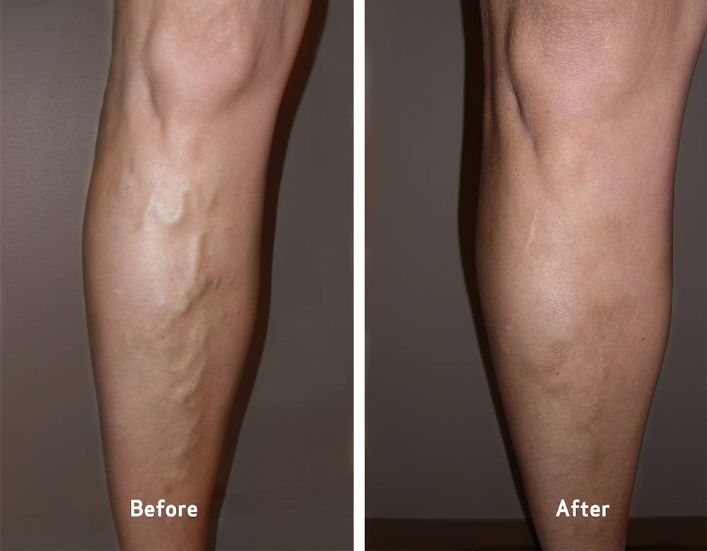 Vein Clinics of America | 232 Crossroads Blvd, Cary, NC 27518 | Phone: (919) 859-1276